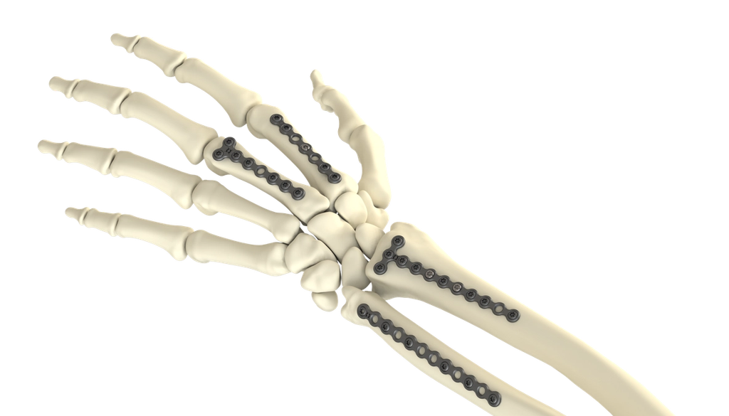 OIC launches value-based Mini Fragment Plating System for hand and wrist surgery